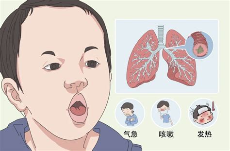 小孩子咳嗽|娃咳嗽不止，不敢喂止咳药，医生教了3个方法，亲测。